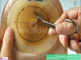 ارتودنسی آماده سازی ایمپلنت