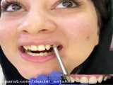 عصب کشی دندان‌های شیری