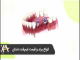 بهترین برند ایمپلنت چیست؟