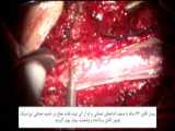 جراحی تومور نخاعی اینترادورال اکسترامدولاری