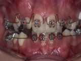 جویدن به کمک ایمپلنت دندان | دکتر سزاوار