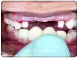 ایمپلنت دندان چگونه است؟ | بهترین متخصص ایمپلنت اصفهان