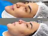 جراحی بینی | دکتر علی حسینی واجاری