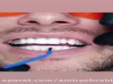 پوسیدگی دندان در اثر لمینت