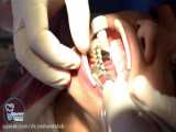 پر کردن دندان در ارتودنسی