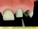 پوسیدگی دندان‌ها و راه‌های مقابله با آن