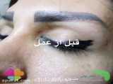 تزریق فیلر در اصفهان