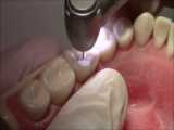 آموزش دندان سازی