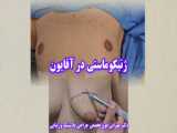 فیلم عمل  ژنیکوماستی_آقایون  بزرگی_سینه_آقایون در شیراز