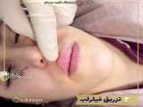 فیلر بدن