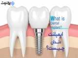 ایمپلنت دندان چیست؟