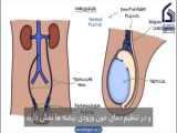 ذات الریه