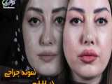 جراحی بینی کمر شکن !