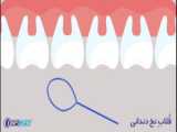 نحوه ایمپلنت کردن در کرج ( دندانپزشکی شبانه روزی )