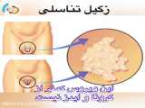 چگونه از شر زگیل خلاص شویم متخصص پوست