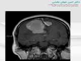 درمان تومور بسیار بزرگ در ناحیه مغزی