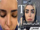 کاشت ابرو در مطب زیبایی لاله