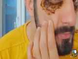 رفع تیرگی حول چشم به صورت رایگان