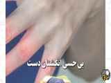 علت کاهش حس انگشت دست