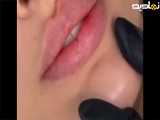 تزریق ژل به لب ها