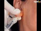 تزریق فیلر هیالورونیک اسید به گوش