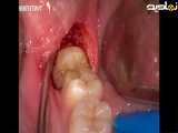 فیلم کامل کشیدن دندان عقل نهفته در لثه