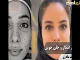پوستی بدون جای جوش = آزادی از آرایش ( کلینیک زیبایی ماه زر )